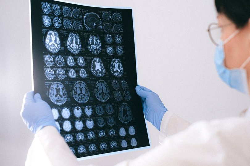 Alzheimer's sleep loss traced to brain immune cells, not plaques alone